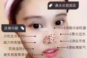 鼻尖长痘怎么消除（鼻尖长痘怎么快速消去）
