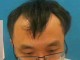 男人发际线后移怎么办（男人发际线后移是怎么回事）
