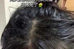 掉头发头皮屑多为什么（掉头发头皮屑多为什么呢）