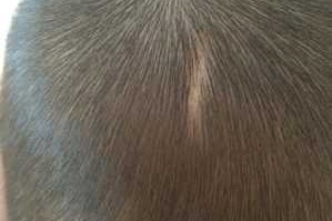 小孩头上有一块没头发还是白色的,头顶没有头发怎么办女的