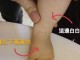 皮肤黄染是什么意思（新生儿皮肤黄染是什么意思）