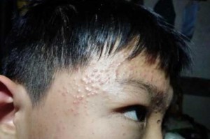 脸上长青春痘怎么办（脸上长青春痘怎么办13岁）