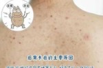 上背长痘痘是什么原因（后背起痘痘什么原因）