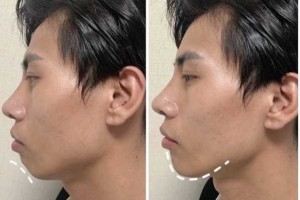 下巴后缩适合什么发型（下巴后缩适合什么发型男）