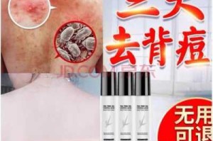 背部长痘用什么药,冬天背上长痘是什么原因