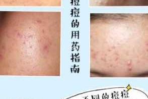 快速治疗痤疮最有效的方法有哪些,怎么消除脸上的痤疮杆菌