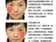 脸上痘痘怎么去除（脸上痘痘怎么去除）