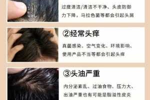 头痒有头屑怎么办（头痒有头屑怎么办最快最有效）