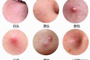 酒刺怎么去除（酒刺怎么去除小窍门）