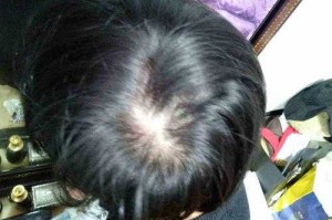 头发稀少怎么办啊（头发稀少怎么办啊）