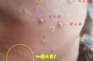什么是闭口粉刺（什么是闭口粉刺图片）