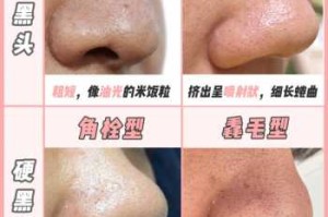 鼻子上黑头很多怎么办（鼻子上有黑头怎么去除）