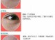 脂肪粒怎么形成的（为什么油脂粒会从毛孔里自己出来）