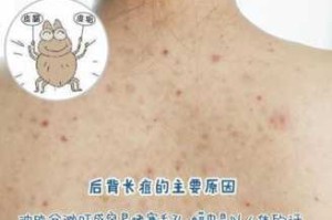 身体后背为什么也会长痘痘,背部痘痘是什么原因引起的
