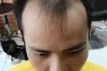 男士前秃适合什么发型（男士前秃适合什么发型视频）
