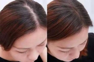 很多短头发怎么办（头发发根短，而且头发很细，出油厉害,怎样预防和治疗脱发）