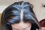 头皮油脱发严重怎么办,油性脱发怎么治疗效果好