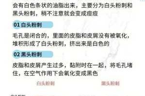 去粉刺最快的方法,怎么去粉刺最快最有效的方法