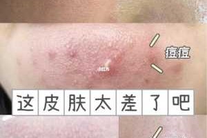什么是闭口痘（有闭口痘痘怎么办）