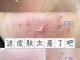 什么是闭口痘（有闭口痘痘怎么办）