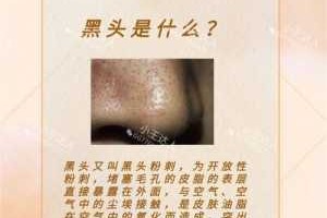 怎么去除黑头（怎么去除黑头鼻子上的黑头）