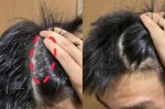 男士头皮屑太多怎么办（男士头皮屑太多怎么办啊）