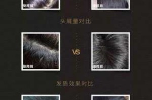 顽固头屑怎么去除（顽固头屑怎么去除小妙招）