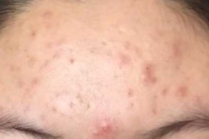 额头痘痘如何消除,额头痘怎么去除小窍门