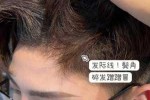 鬓角脱发怎么治疗（请问大夫秃鬓角怎么治）
