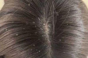 怎么才能没有头皮屑,怎么样减少头皮屑的产生
