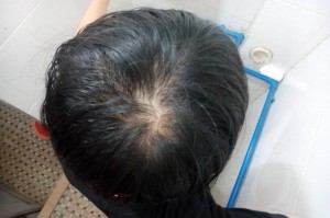 头发稀少怎么改善（头发变少怎么办）