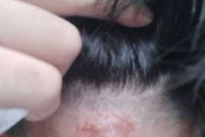 烫头把头皮烫破怎么处理,烫头发头皮烫伤怎么办要怎样赔