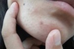 下巴上的粉刺怎么去掉（下巴上的粉刺怎么去掉图片）