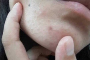 下巴上的粉刺怎么去掉（下巴上的粉刺怎么去掉图片）