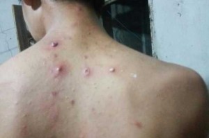 后背一直有痘痘,是什么原因,要怎样才能消除呢,初中男生背上长痘怎么办