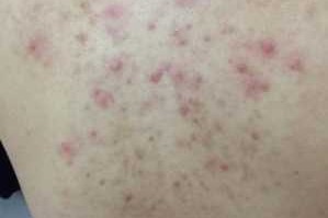 背上长痘痘怎么消除（背部痘痘如何消除）