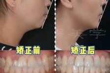 凸型脸怎么（凸型脸怎么矫正）