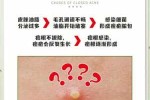 粉刺该如何去除,怎么消除粉刺最快最有效