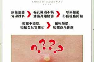 粉刺该如何去除,怎么消除粉刺最快最有效