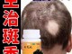 治疗脱发的最好方法,掉头发用什么好的方法不掉