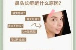 鼻子上长痘痘是怎么办（鼻子上有痘怎么去掉）
