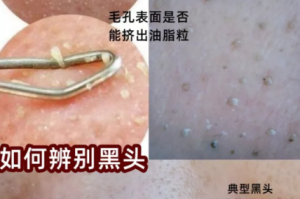 黑头多的原因,脸上有黑头是什么原因