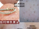 黑头多的原因,脸上有黑头是什么原因