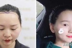 美人尖怎么（怎么把美人尖去掉）