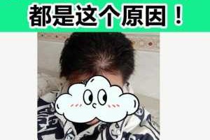 掉头发严重是什么原因（掉头发严重是什么原因男性）