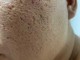 男士脸部毛孔粗大黑头怎么解决,男士毛孔粗有黑头怎么办呢
