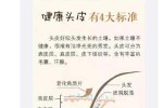 脱发是何原因,脱发主要是什么原因引起的