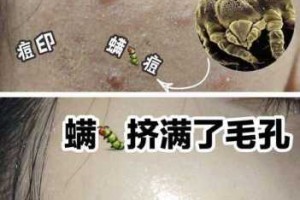 毛孔黑头怎么去掉（怎么解决黑头毛孔粗大）