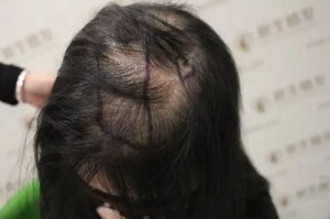 17岁女孩子掉头发好厉害是什么原因,女孩头发掉的厉害是什么原因怎么办