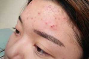 脸上长痘痘怎么治啊（脸上长痘痘怎么治啊?）
